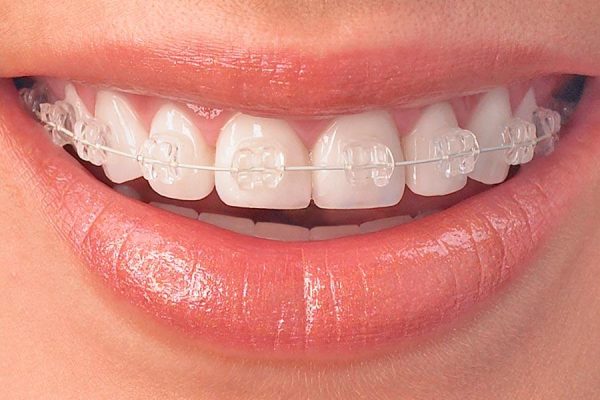 Niềng răng quận 8 mắc cài sứ