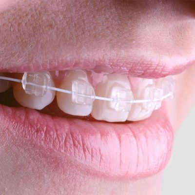 Ưu điểm niềng răng mắc cài sứ quận 8