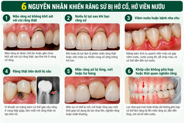6 Nguyên Nhân Hở Viền Nướu Răng Sứ