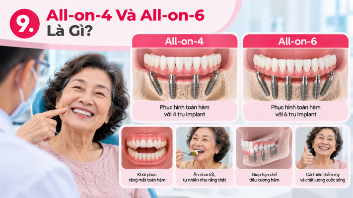 All-on-4 và All-on-6_ Giải pháp toàn hàm - Trồng răng cấy ghép Implant HCM (ảnh minh họa)