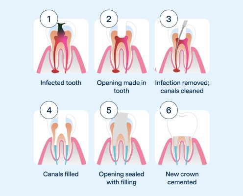 Chữa Tủy Răng Quận 8 – Khi Nào Cần Điều Trị Tủy? 8 Ảnh mô tả các mức độ sâu răng - Chứa tủy răng quận 8 - Nha khoa An An