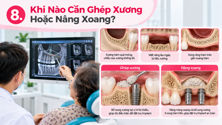 Khi nào cần ghép xương hoặc nâng xoang_Cấy ghép Implant TPHCM Quận 8 Nha khoa An An Dental Care