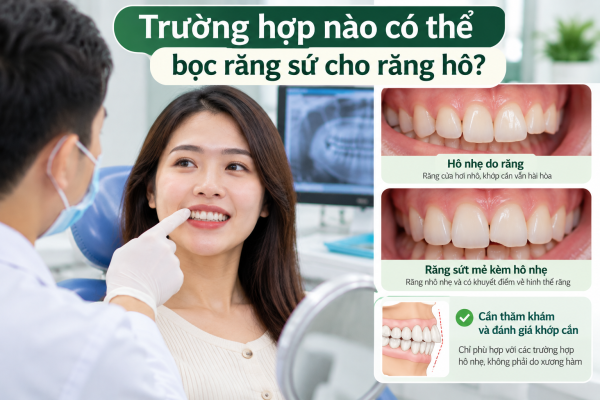 Khi nào có thể bọc răng sứ cho răng hô_