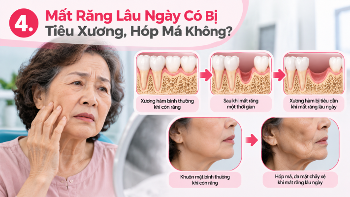 Mất Răng Lâu Ngày_ Tiêu Xương, Hóp Má - Trồng răng cấy ghép Implant HCM Quận 8 Nha khoa AN AN Dental Care