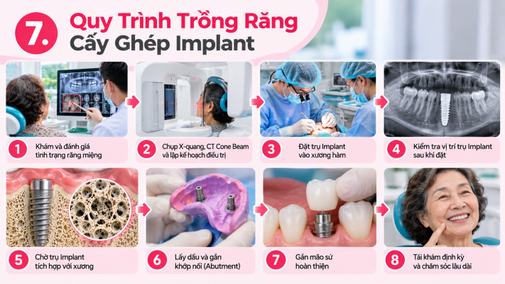 Quy Trình Trồng Răng Implant - Dịch vụ cấy Implant TPHCM Quận 8 -Nha khoa An An Dental Care (Ảnh minh họa)