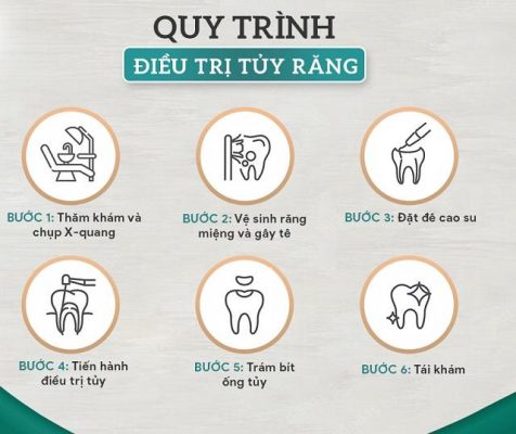Chữa Tủy Răng Quận 8 – Khi Nào Cần Điều Trị Tủy? 6 Quy trình chữa tủy răng quận 8