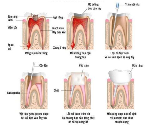 Chữa Tủy Răng Quận 8 – Khi Nào Cần Điều Trị Tủy? 2 Quy trình chữa tủy răng quận 8 - Nha khoa An An
