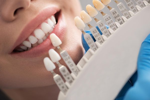 So màu khi làm răng sứ thẩm mỹ - Địa chỉ bọc răng sứ đẹp tại quận 8 TPHCM So màu khi làm răng sứ thẩm mỹ - Địa chỉ bọc răng sứ đẹp tại quận 8 TPHCM