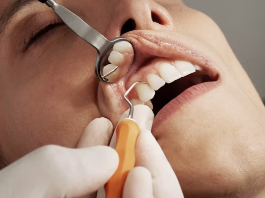 Cạo Vôi Răng Quận 8 Giá Bao Nhiêu? Bảng Giá Nha Khoa An An 3 Cạo vôi răng quận 8 giá bao nhiêu? Cận cảnh cạo vôi răng