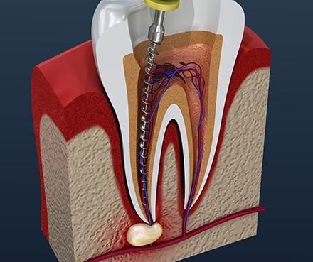 Chữa Tủy Răng Quận 8 – Khi Nào Cần Điều Trị Tủy? 5 cấu tạo răng và tủy răng - Chữa tủy răng quận 8 Nha khoa An An